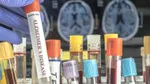 Alzheimer'a Son! FDA Onaylı Test Kiti Erken Teşhiste Çığır Açıyor!